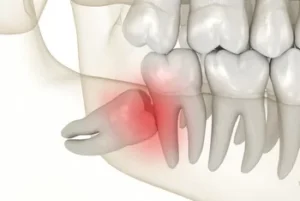 Why Early Evaluation of Wisdom Teeth Saves You from Bigger Problems