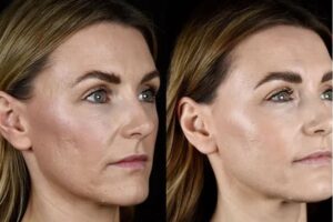 Skin Booster for Acne Scars: What to Expect Before and After Treatment
